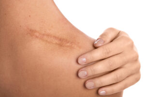 woman with scar voltage